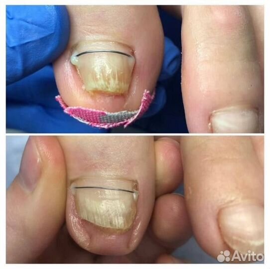 Подолог. Медицинский педикюр. Титановая нить