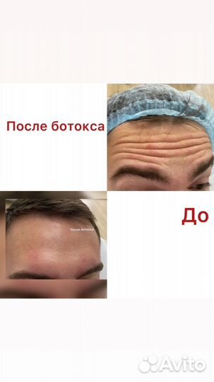 Ботокс для лица