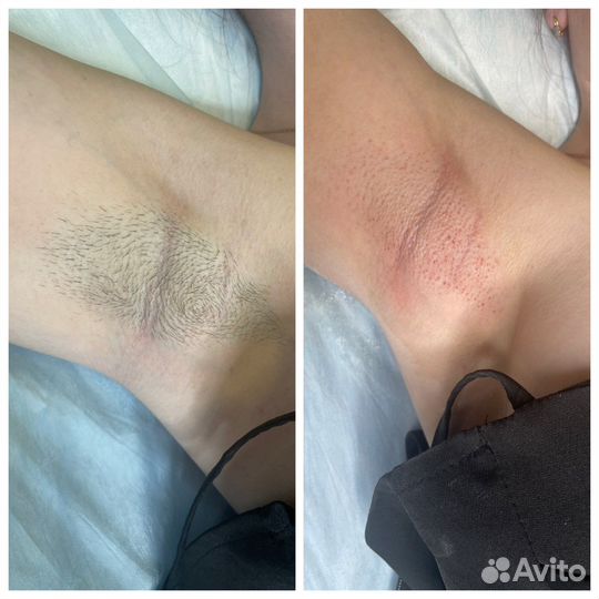 Шугаринг: классическое бикини