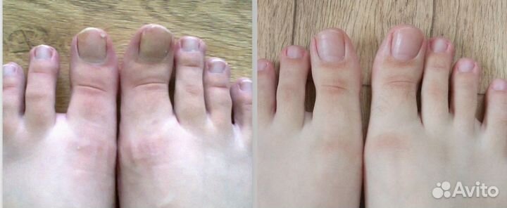 Средство от грибка ногтей широкого действия