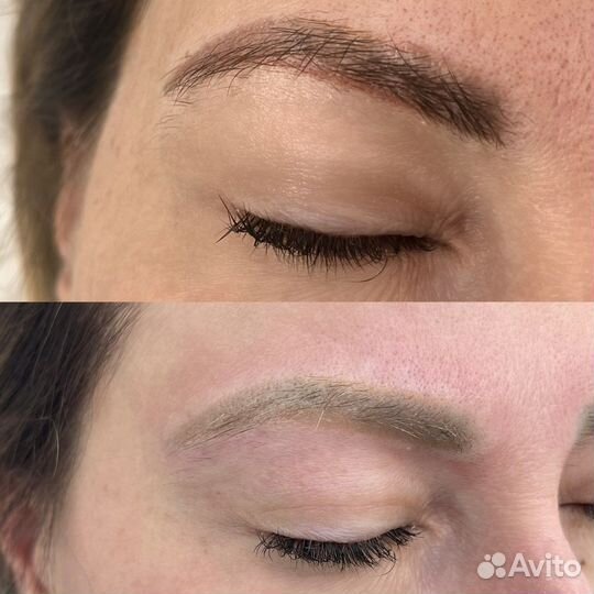 Лазерное удаление тату татуажа