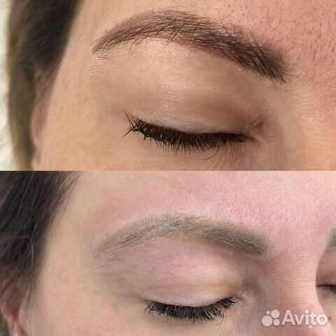 Лазерное удаление тату татуажа