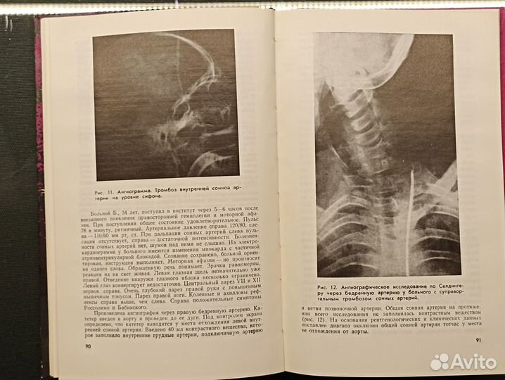 Хирургия острых мозговых инсультов. 1970