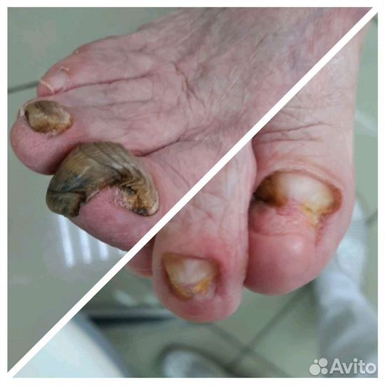 Подологическая зачистка. Подолог с выездом на дом