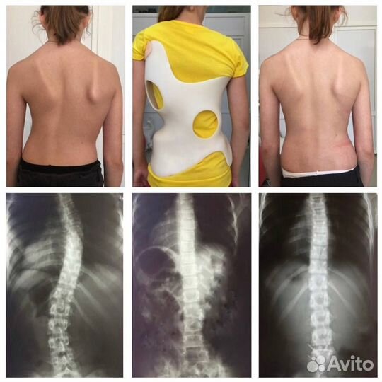 Лечение сколиоза корсетом Шено
