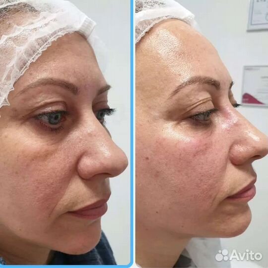 СМАС лифтинг