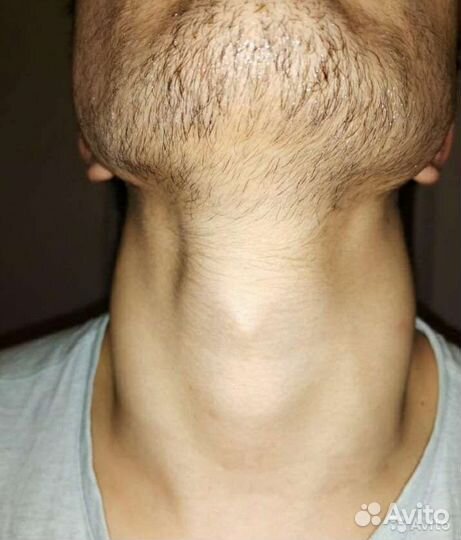 Миноксидил для бороды