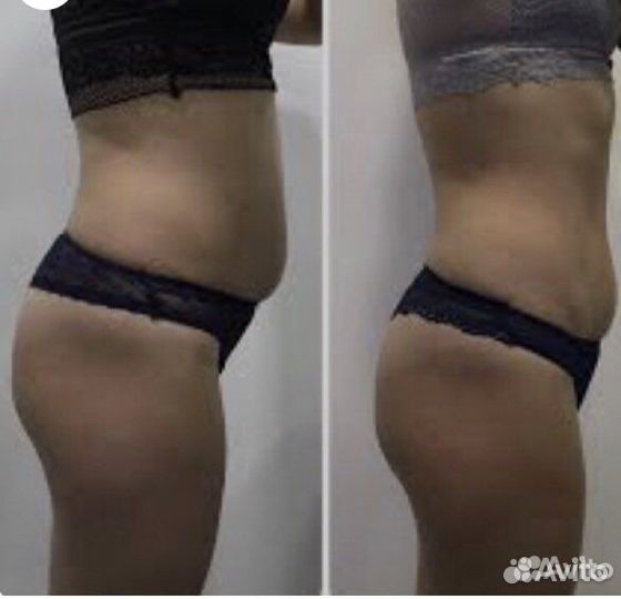 Аппаратная коррекция фигуры (всего тела)