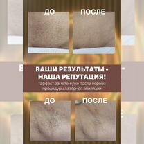 Лазерная эпиляция диодным лазером подмышки бикини, Санкт-Петербург
