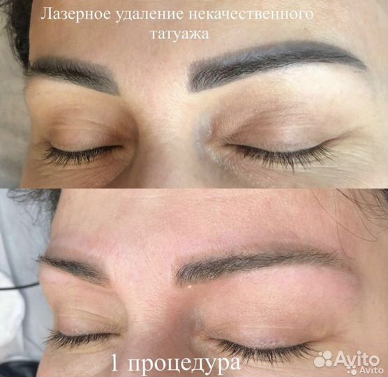 Удаление перманентного макияжа,тату, татуировок