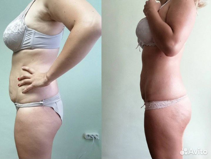 Антицеллюлитный массаж