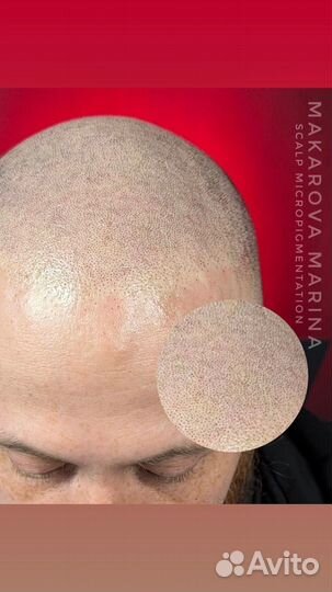 Трихопигментация головы