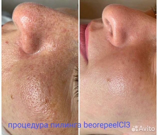 Пилинг лица ретинолом