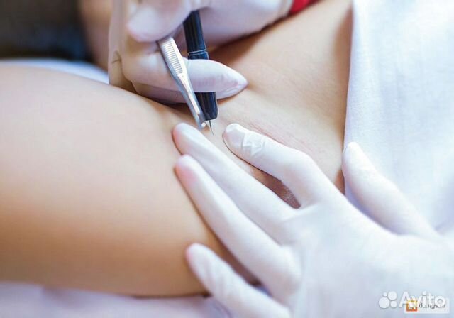 Мастер по электроэпиляции