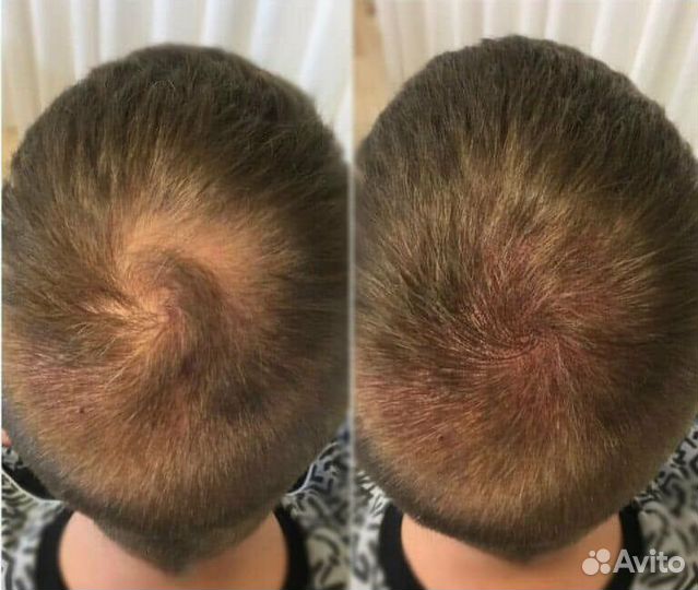 Трихопигментация головы