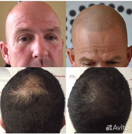 Трихопигментация алопеция головы камуфляж залысин