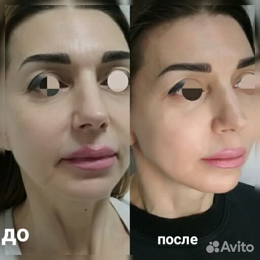 Холодная плазма, Импульсная спрей-коагуляция кожи