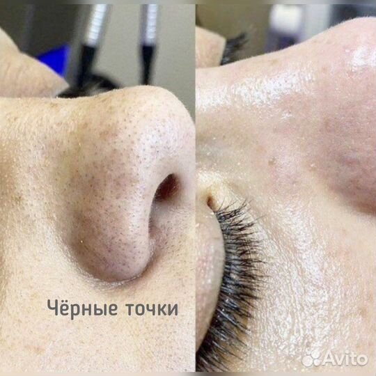 Косметолог/Челны/Чистка лица