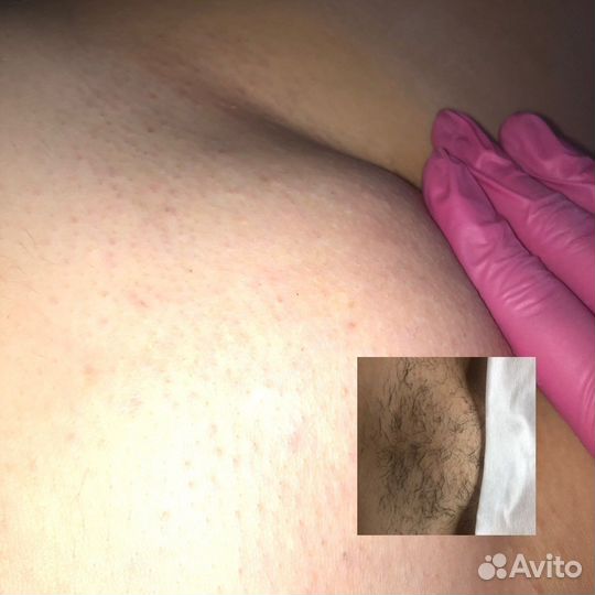 Депиляция воском: глубокое бикини