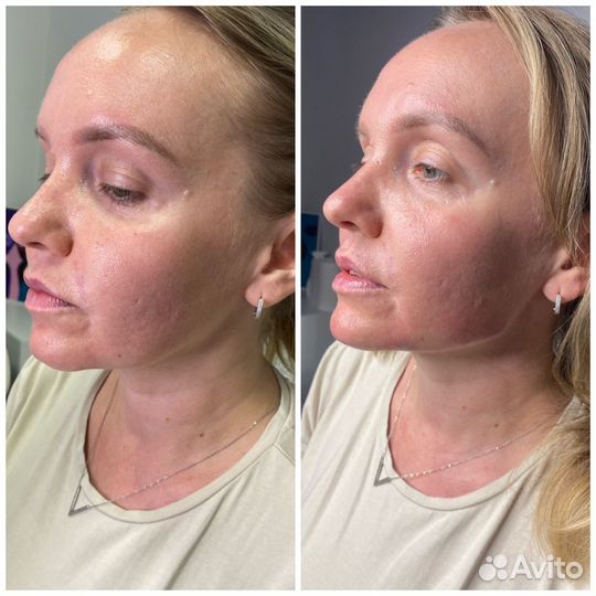 Увеличение губ