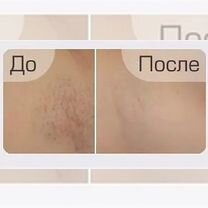Шугаринг, Энгельс