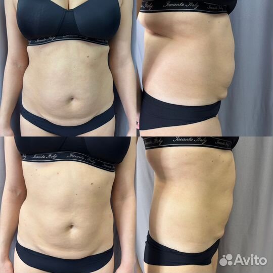 Rf лифтинг лица