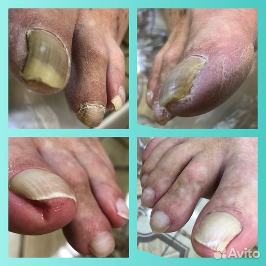 Подологическая зачистка. Подолог с выездом на дом