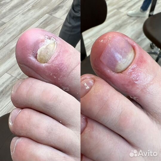 Подология / медицинский педикюр / SMART педикюр