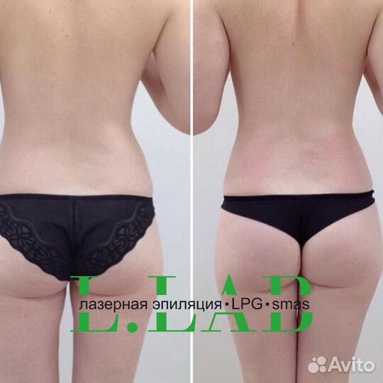 Lpg массаж Коррекция фигуры Похудение