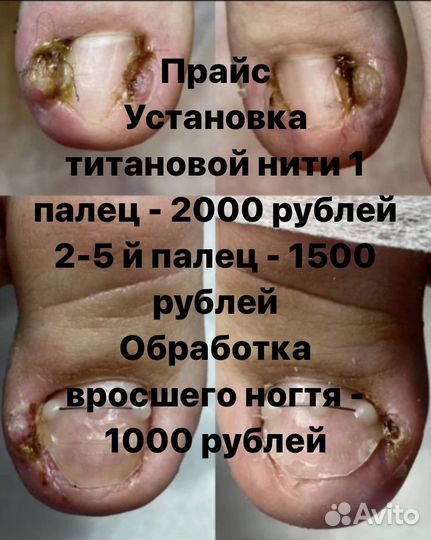 Подолог педикюр