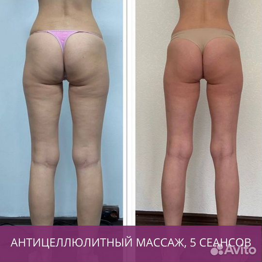 Массаж (все виды), LPG массаж, коррекция фигуры