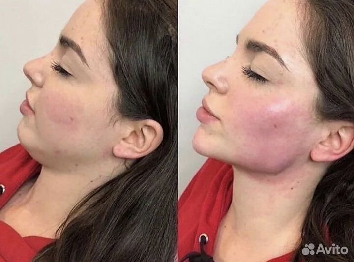 Контурная пластика лица