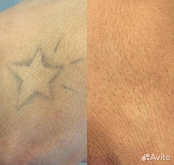 Удаление тату татуажа любых цветов