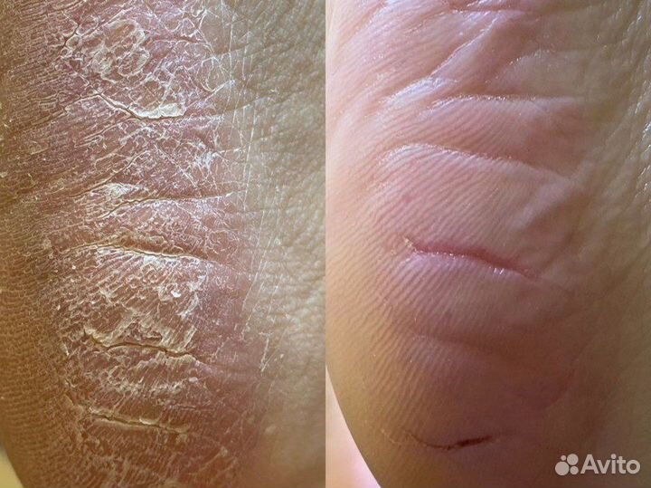 Медицинский педикюр/подолог