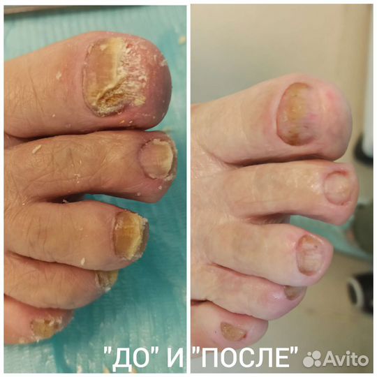 Подология, педикюр