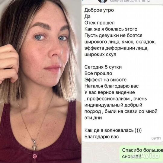 Подтяжка лица нитями ког мезонити моно