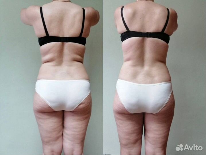 Антицеллюлитный массаж