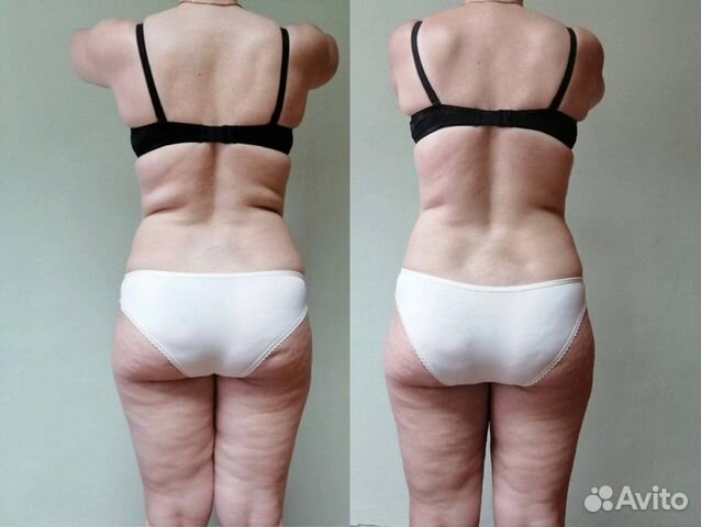 Антицеллюлитный массаж