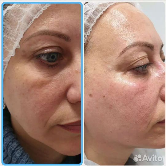 СМАС лифтинг