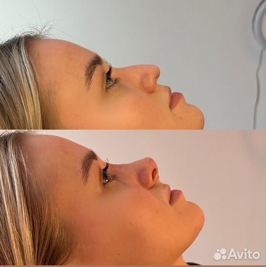 Косметолог. Уменьшение носа навсегда