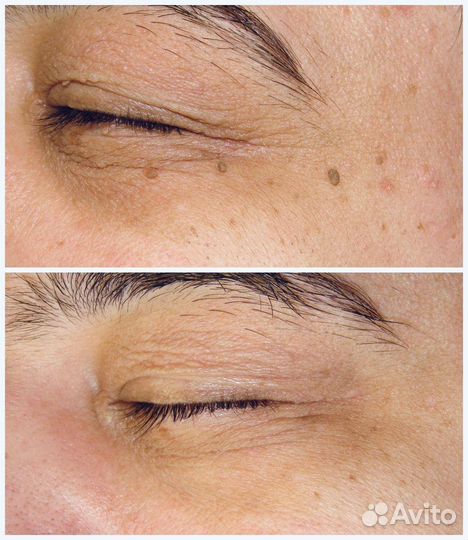 Удaление папиллoм, бородавок, новоoбрaзовaний