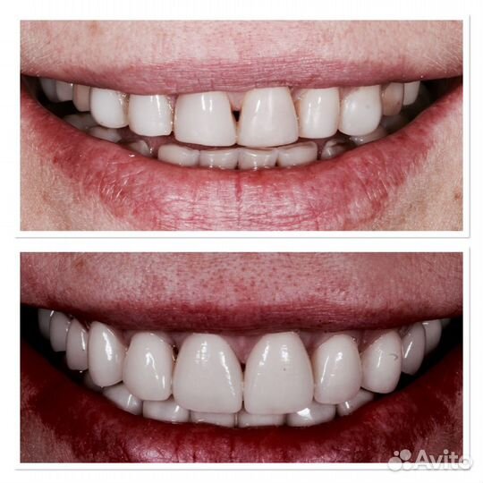 Услуги зуботехнической лаборатории(зубные протезы)