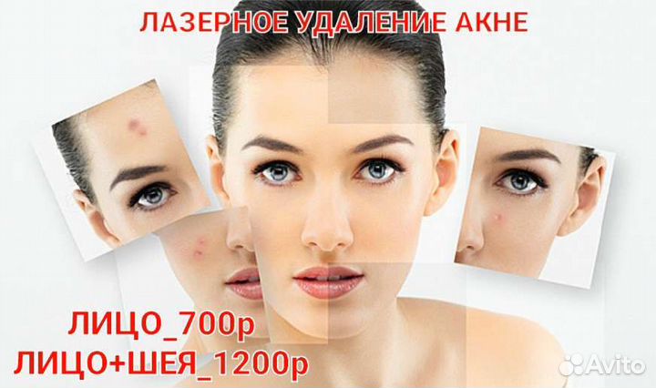 Элос омоложение,Лазерное удаление акне, купероза