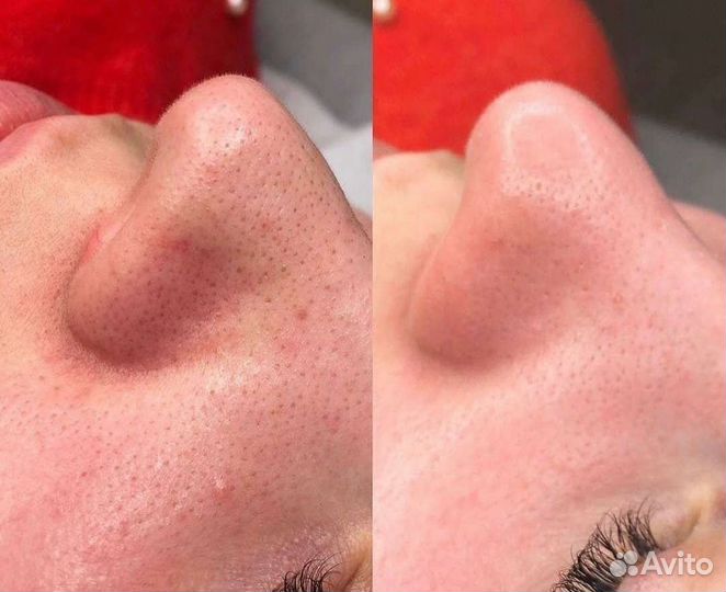 Чистка лица