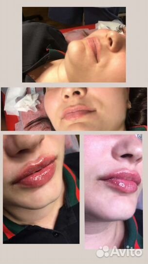 Увеличение губ, наращивание ресниц
