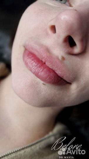 Увеличение губ
