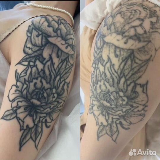 Удаление татуировок