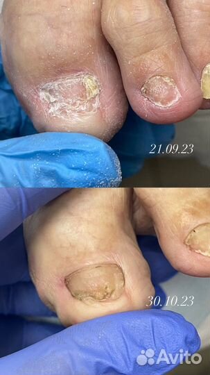 Подолог . Вросший ноготь