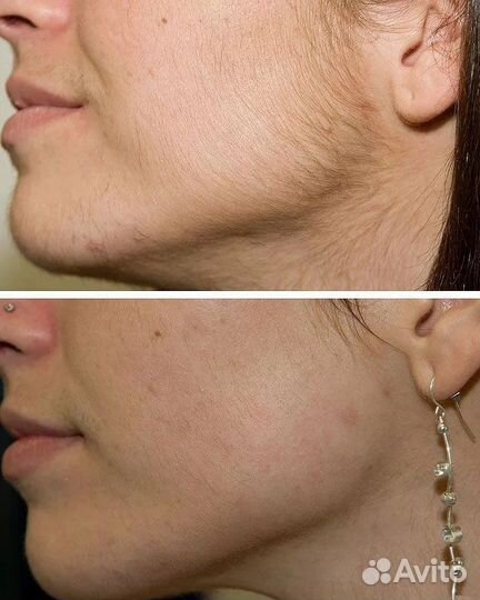 Лазерная эпиляция: верхняя губа