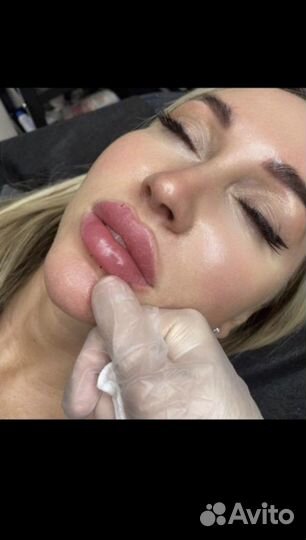 Модель Аугментация губ/ ронопластика